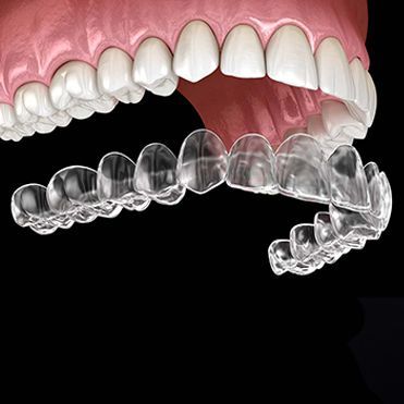 Invisalign treatment result